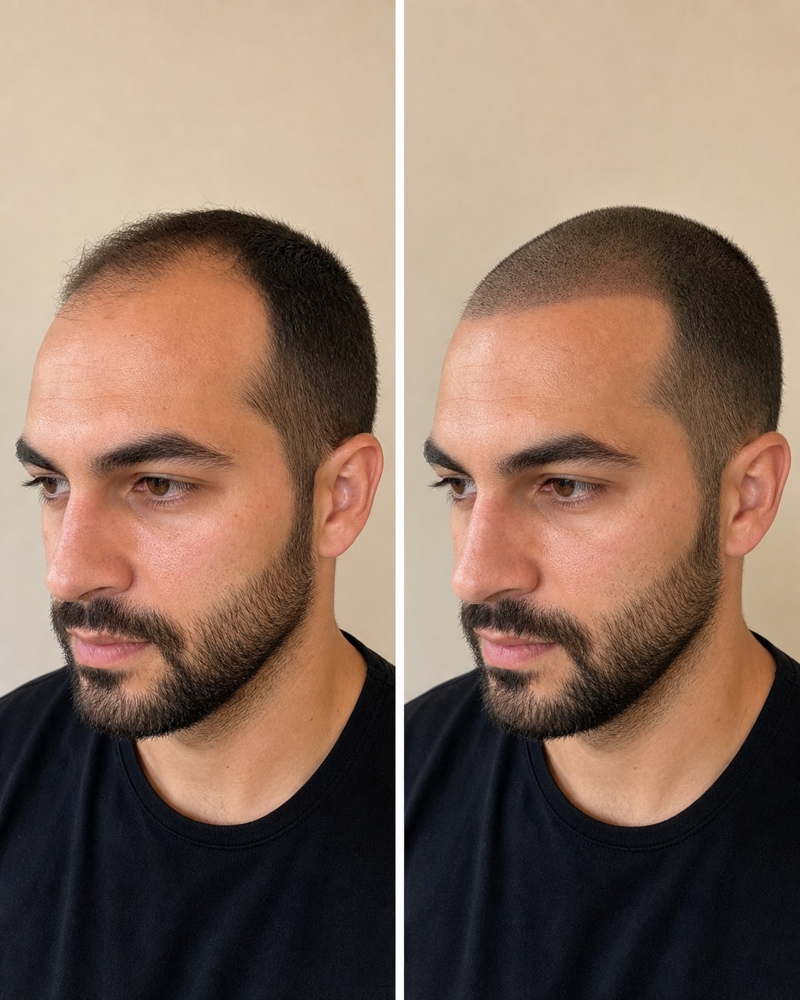 Illustrative comparison: Natural hairline planning